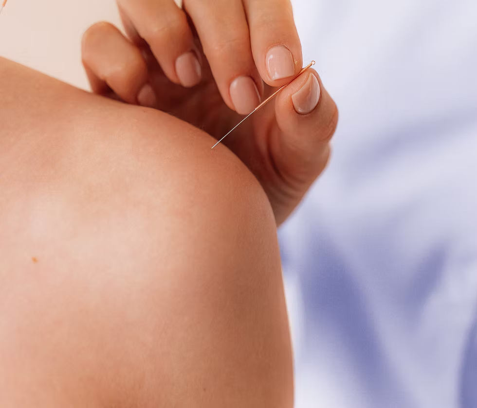 Shoulder acupuncture